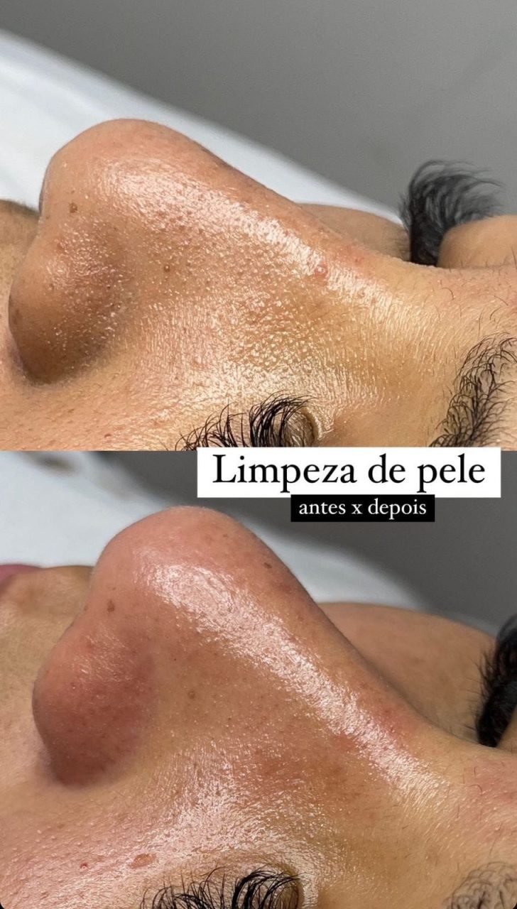 Limpeza de Pele