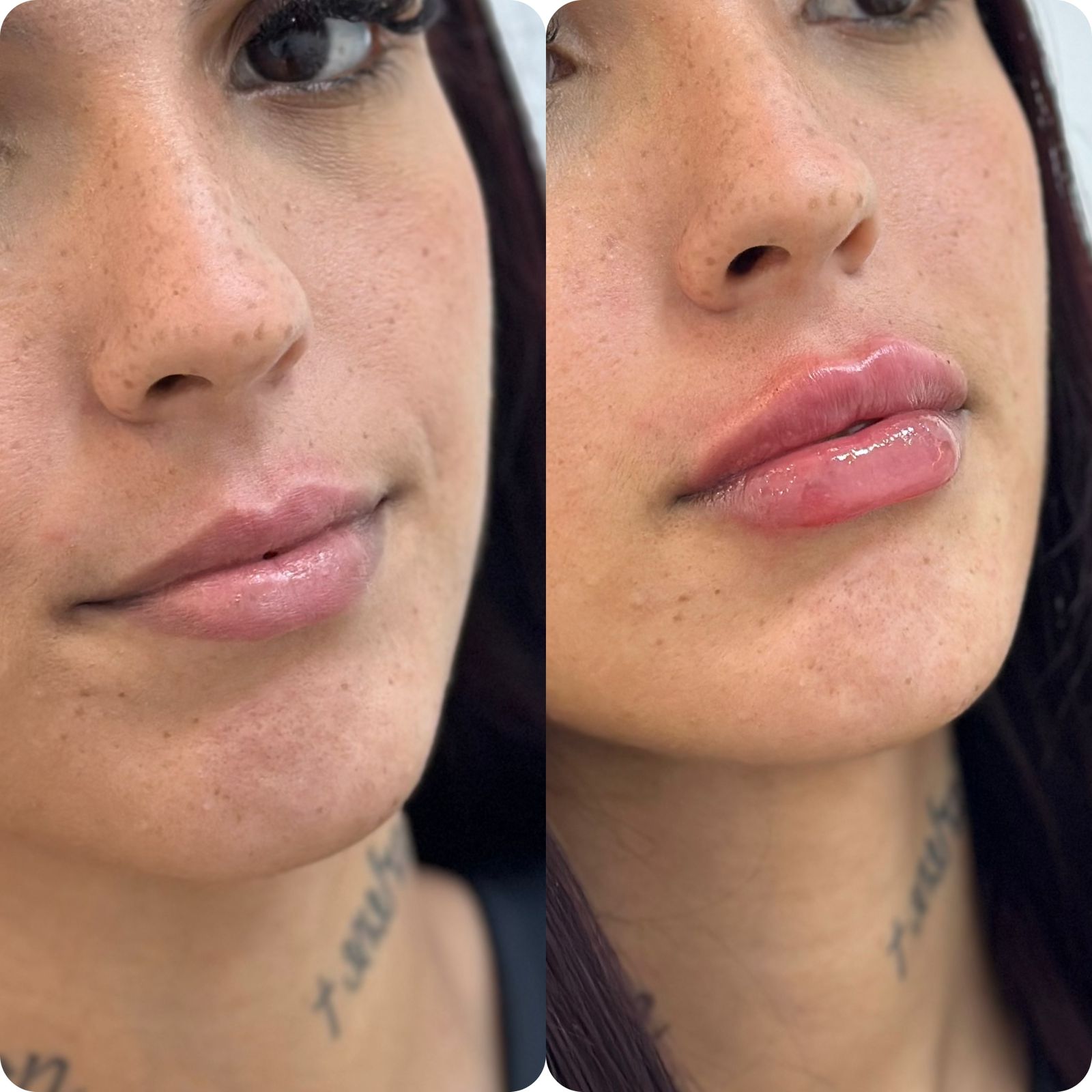 Preenchimento Labial