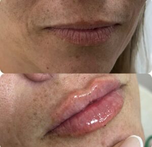 Antes e depois preenchimento Labial 3