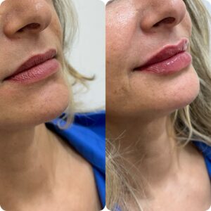 Antes e depois Preenchimento Labial Natural