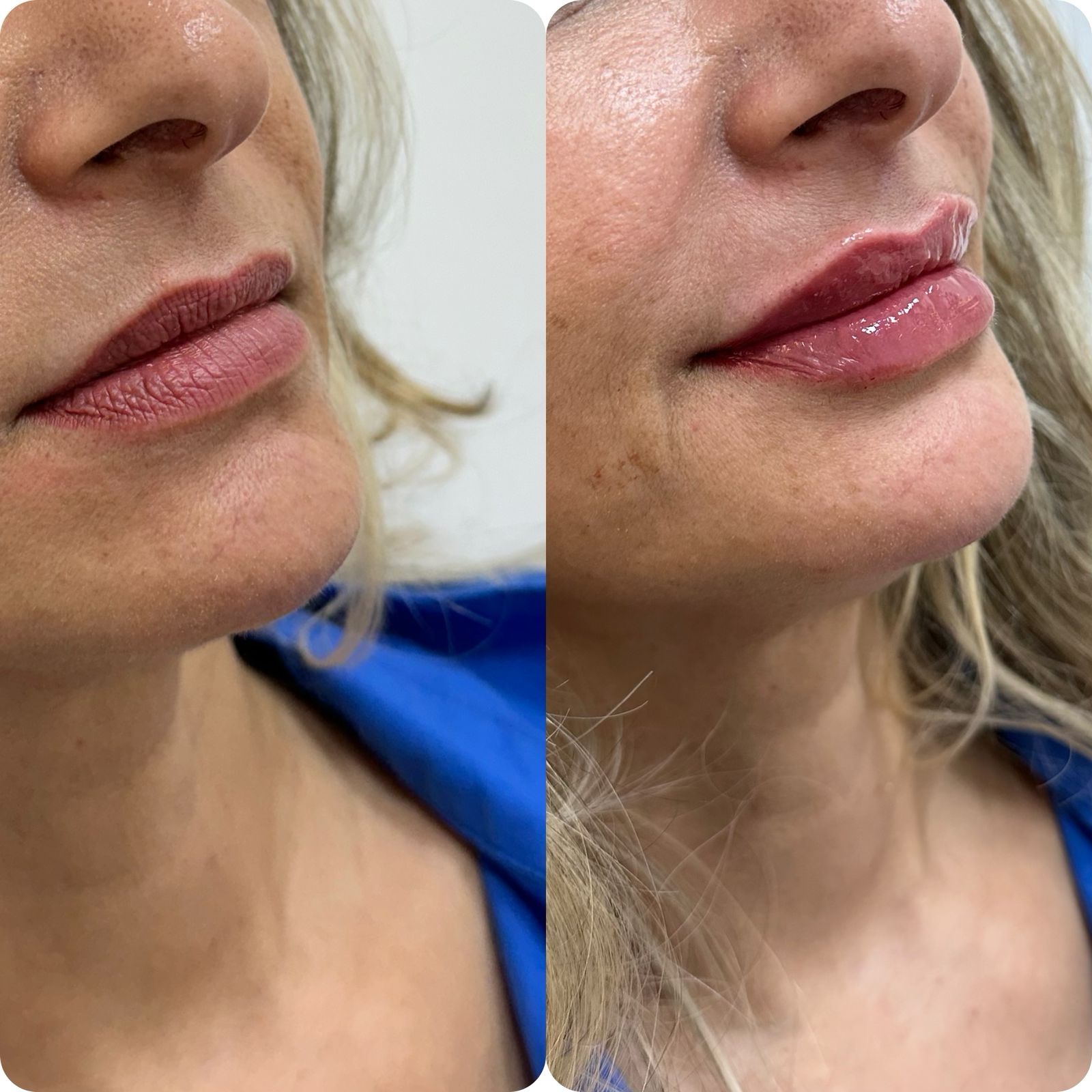 Preenchimento Labial