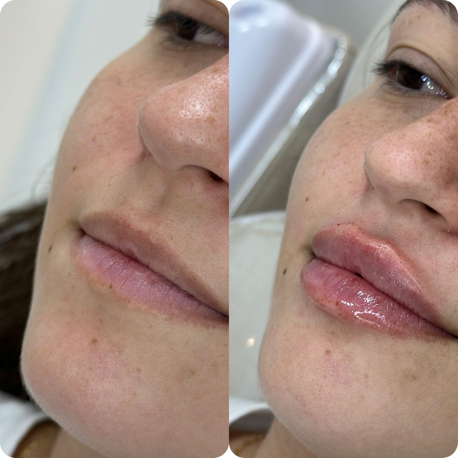 Preenchimento Labial