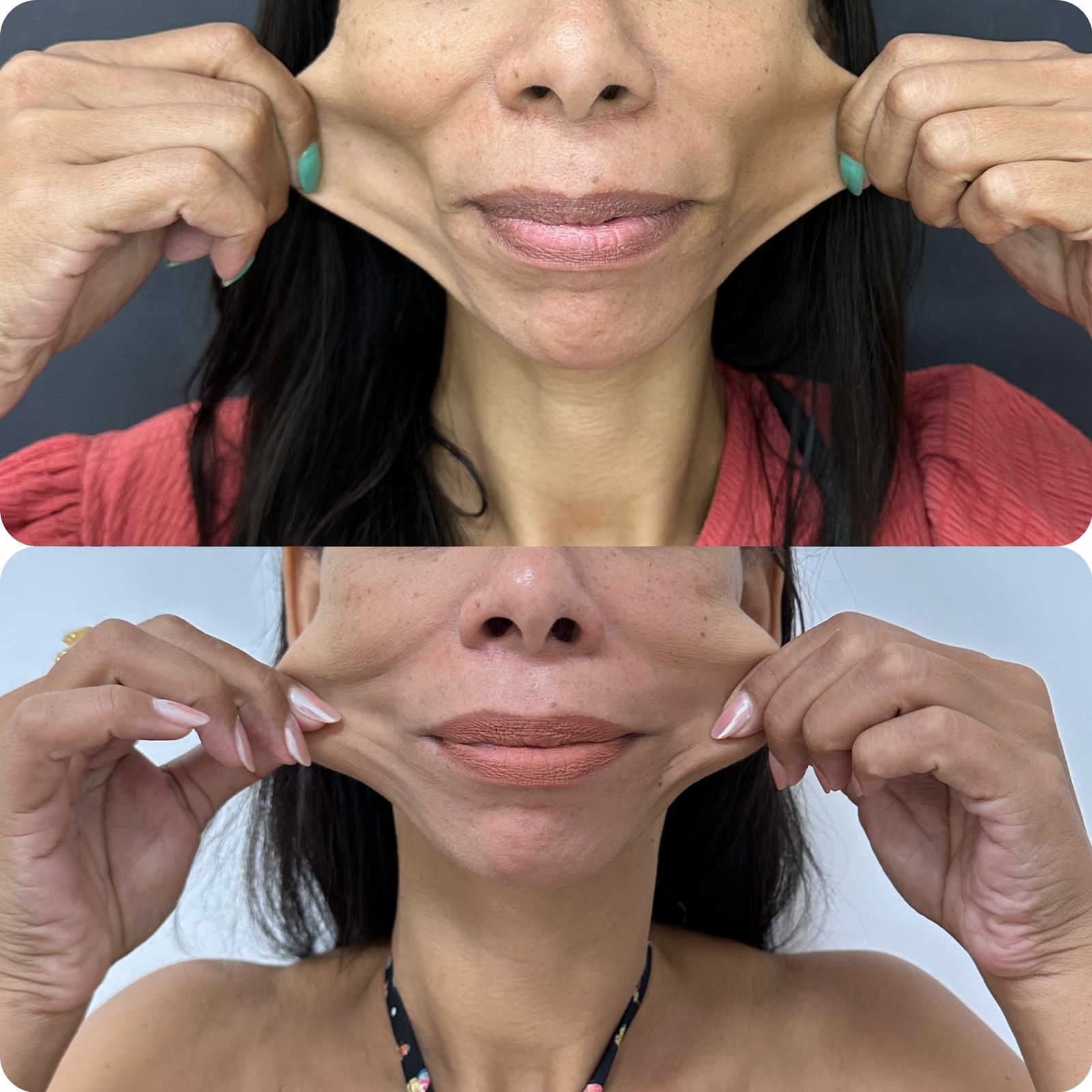 Bioestimuladores