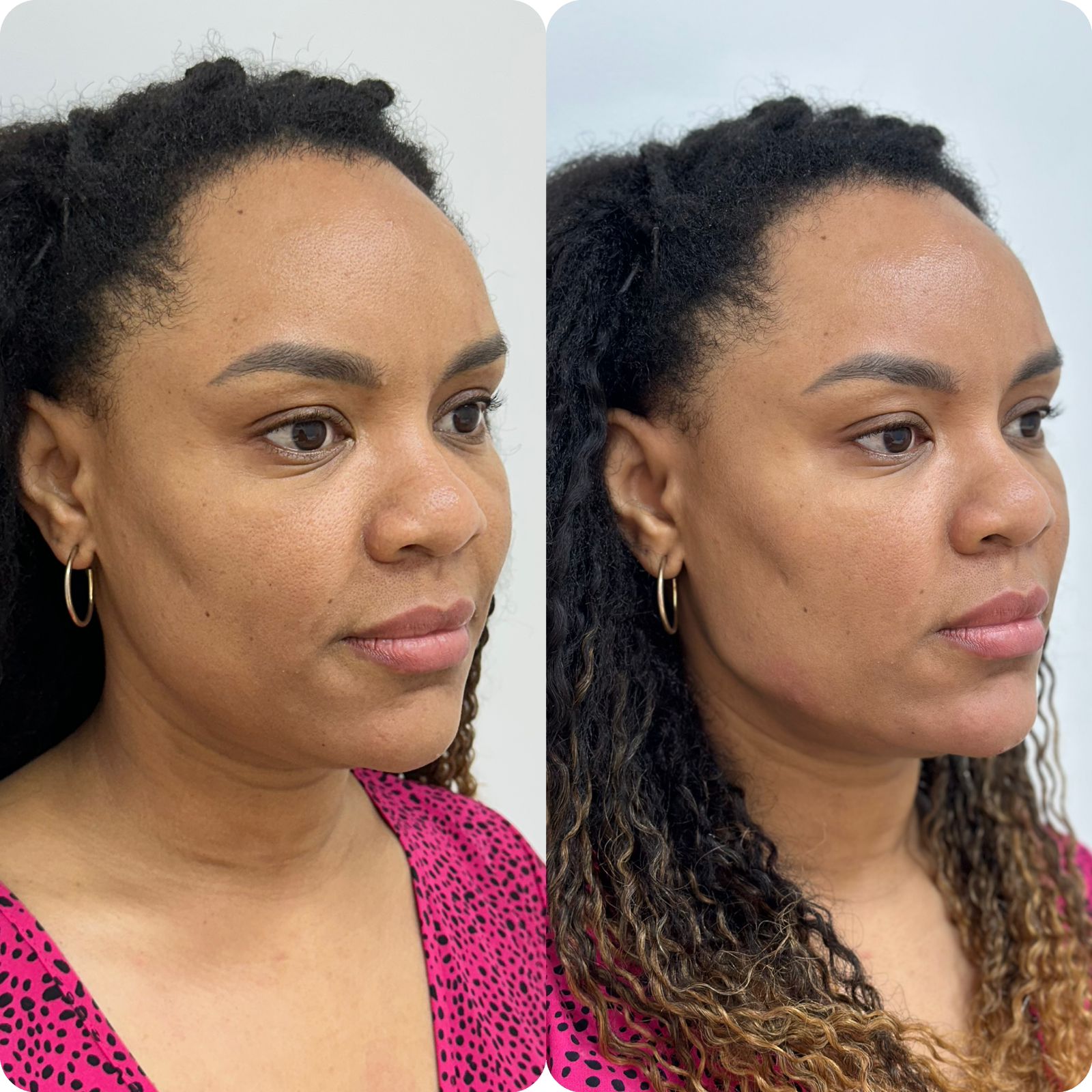 Harmonização Facial