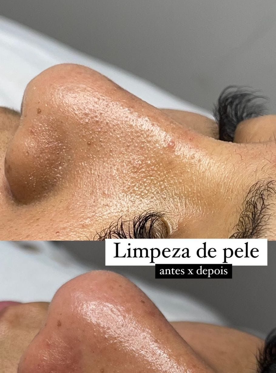 Limpeza de Pele